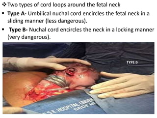 Two types of cord loops around the fetal neck
 Type A- Umbilical nuchal cord encircles the fetal neck in a
sliding manner (less dangerous).
 Type B- Nuchal cord encircles the neck in a locking manner
(very dangerous).
TYPE B
 