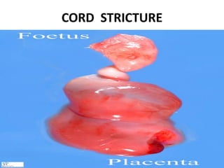 CORD STRICTURE
 