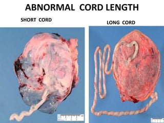 ABNORMAL CORD LENGTH
SHORT CORD
LONG CORD
 