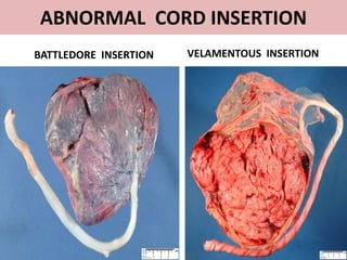 Umbilical cord and cord abnormalities | PPT