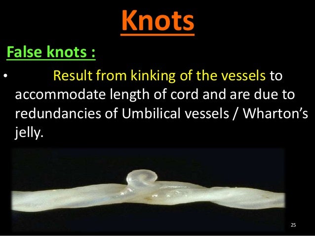 umbilical cord knot