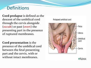 Definitions
Cord prolapse is defined as the
descent of the umbilical cord
through the cervix alongside
(occult) or past (overt) the
presenting part in the presence
of ruptured membranes.
Cord presentation is the
presence of the umbilical cord
between the fetal presenting
part and the cervix, with or
without intact membranes.
 