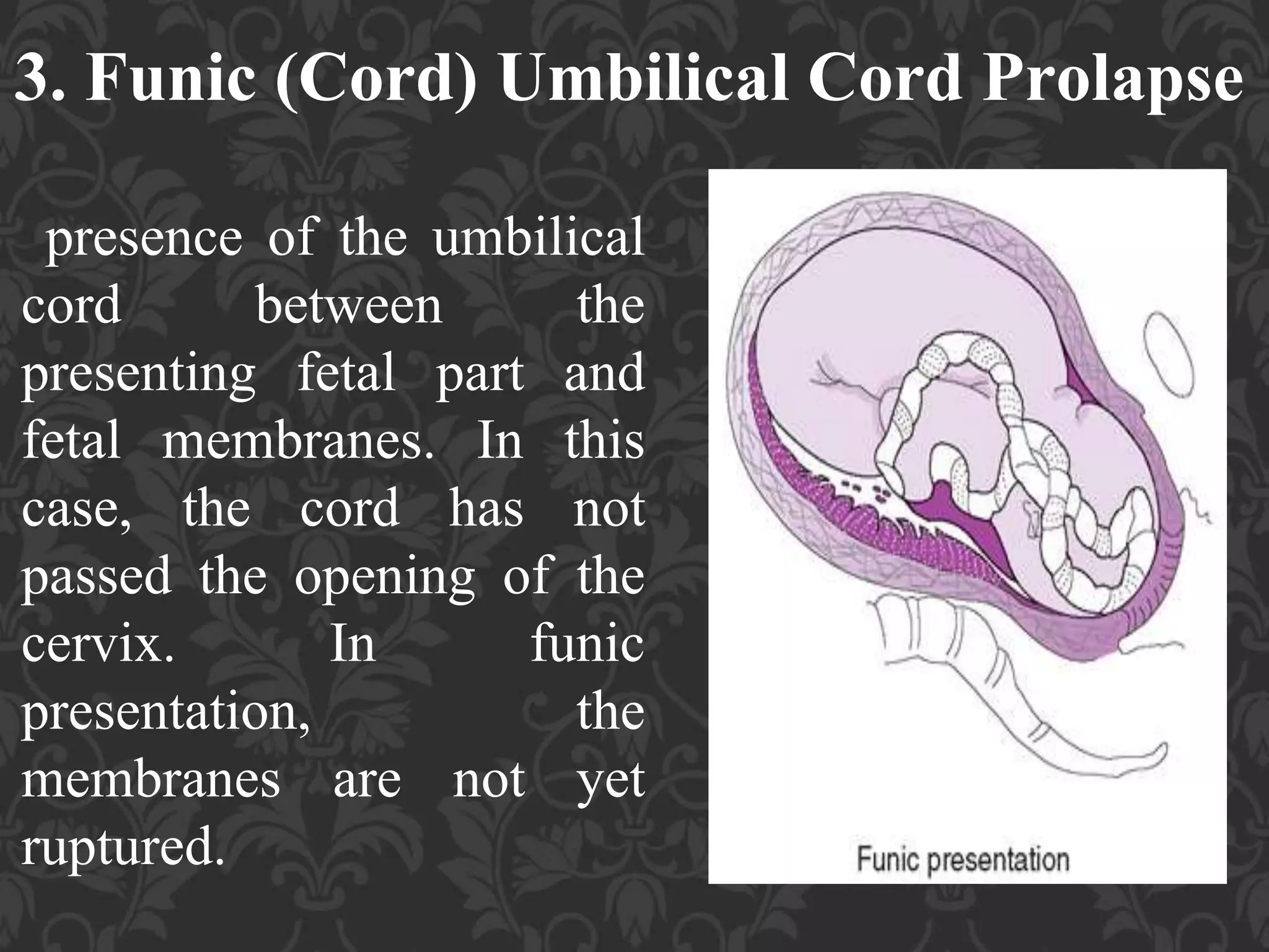 Funic Decompression Umbilical Cord Prolapse, Presented By Mohammed Haroon Rashid | PPTX