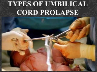 Umbilical Cord Prolapse, Presented By Mohammed Haroon Rashid