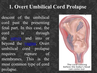 Umbilical Cord Prolapse, Presented By Mohammed Haroon Rashid