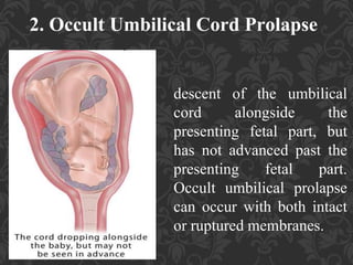 Umbilical Cord Prolapse, Presented By Mohammed Haroon Rashid