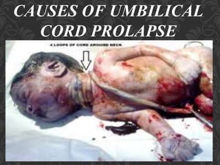 Umbilical Cord Prolapse, Presented By Mohammed Haroon Rashid