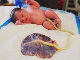 Umbilical Cord Prolapse, Presented By Mohammed Haroon Rashid