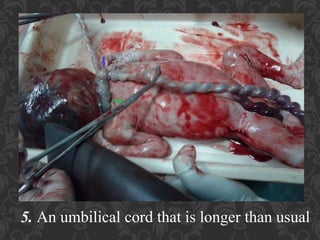 Umbilical Cord Prolapse, Presented By Mohammed Haroon Rashid