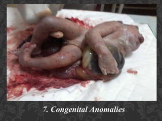 Umbilical Cord Prolapse, Presented By Mohammed Haroon Rashid