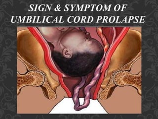 Umbilical Cord Prolapse, Presented By Mohammed Haroon Rashid