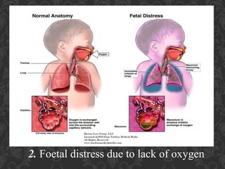 Umbilical Cord Prolapse, Presented By Mohammed Haroon Rashid
