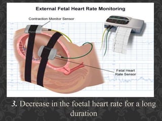 Umbilical Cord Prolapse, Presented By Mohammed Haroon Rashid