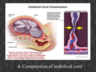 Umbilical Cord Prolapse, Presented By Mohammed Haroon Rashid