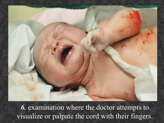Umbilical Cord Prolapse, Presented By Mohammed Haroon Rashid