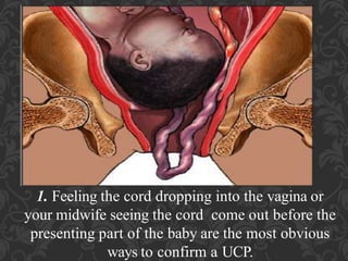 Umbilical Cord Prolapse, Presented By Mohammed Haroon Rashid