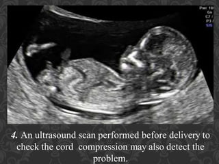 Umbilical Cord Prolapse, Presented By Mohammed Haroon Rashid
