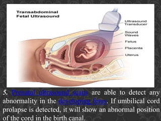 Umbilical Cord Prolapse, Presented By Mohammed Haroon Rashid