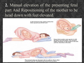 Umbilical Cord Prolapse, Presented By Mohammed Haroon Rashid