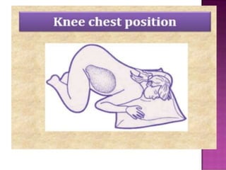 Umbilical Cord Prolapse, Presented By Mohammed Haroon Rashid