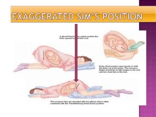 Umbilical Cord Prolapse, Presented By Mohammed Haroon Rashid