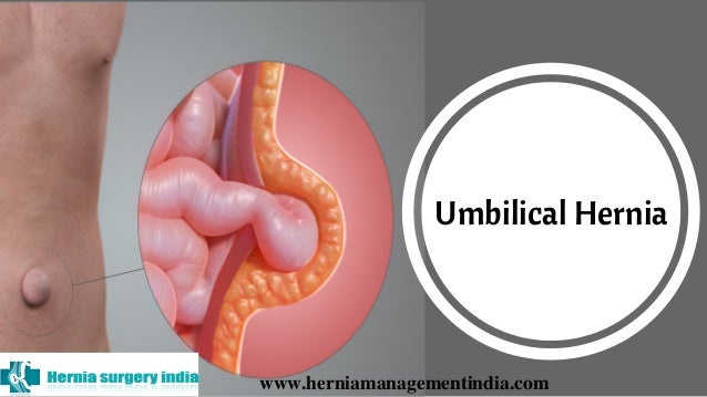 Umbilical Hernia Repair Surgery In Chennai Hernia Treatment For Fem 
