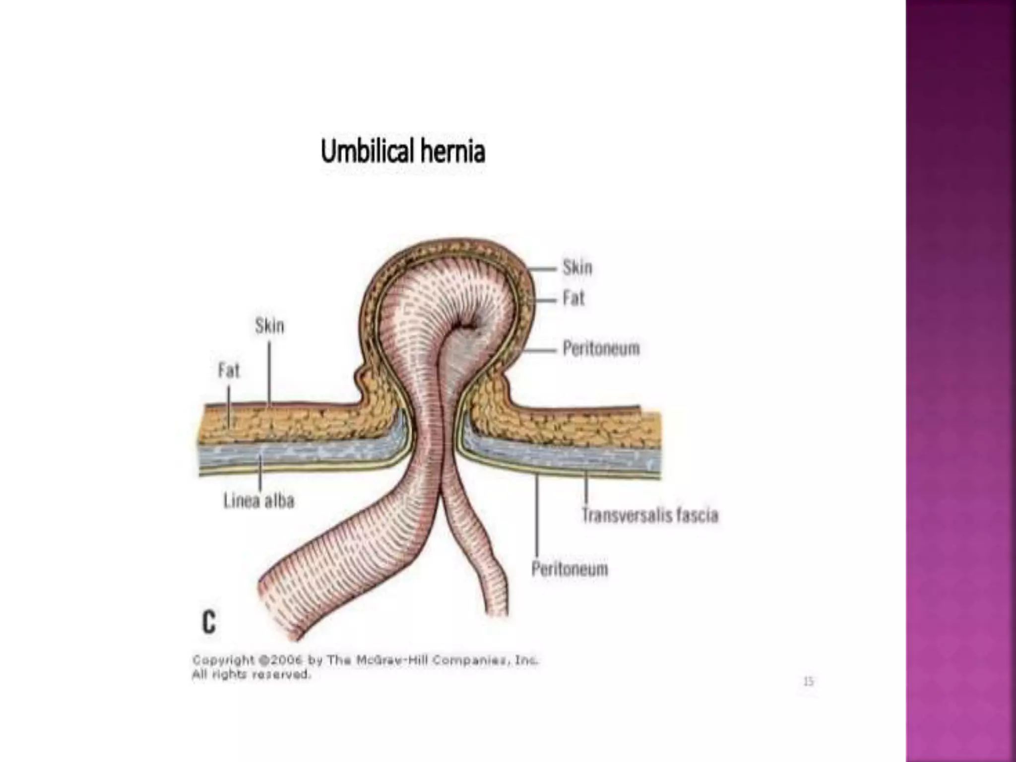Umbilical Inverted Umbilical hernia by Dr. kiran maindale | PPTX | Pregnancy ...