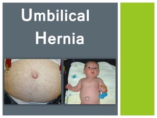 Umbilical
Hernia
 