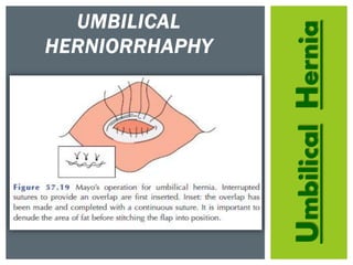 UmbilicalHernia
UMBILICAL
HERNIORRHAPHY
 