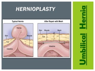 UmbilicalHernia
HERNIOPLASTY
 
