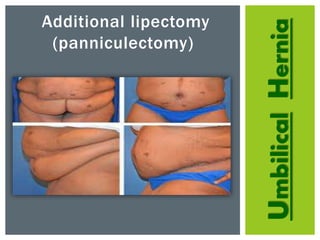 UmbilicalHernia
Additional lipectomy
(panniculectomy)
 