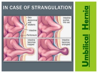 UmbilicalHernia
IN CASE OF STRANGULATION
 