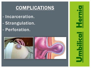 UmbilicalHernia
COMPLICATIONS
- Incarceration.
- Strangulation.
- Perforation.
 