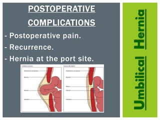 UmbilicalHernia
POSTOPERATIVE
COMPLICATIONS
- Postoperative pain.
- Recurrence.
- Hernia at the port site.
 