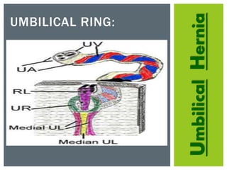 UmbilicalHernia
UMBILICAL RING:
 