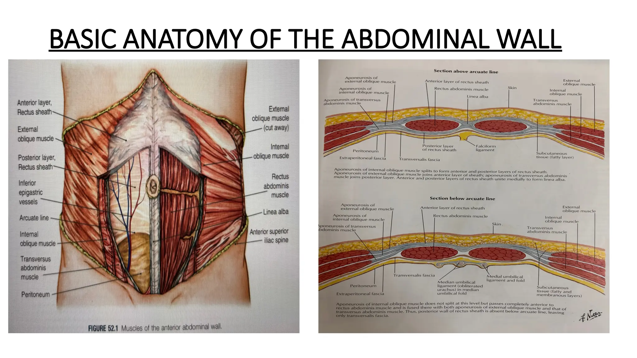 Umbilical Inverted Umbilical Hernia- A Comprehensive presentation on various surgical ...