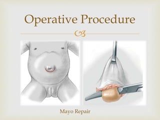 
Operative Procedure
Mayo Repair
 