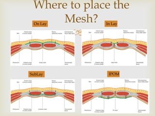 
Where to place the
Mesh?On Lay In Lay
SubLay IPOM
 