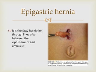 
Epigastric hernia
 It is the fatty herniation
through linea alba
between the
xiphisternum and
umbilicus.
 