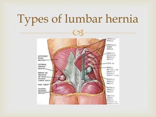 
Types of lumbar hernia
 