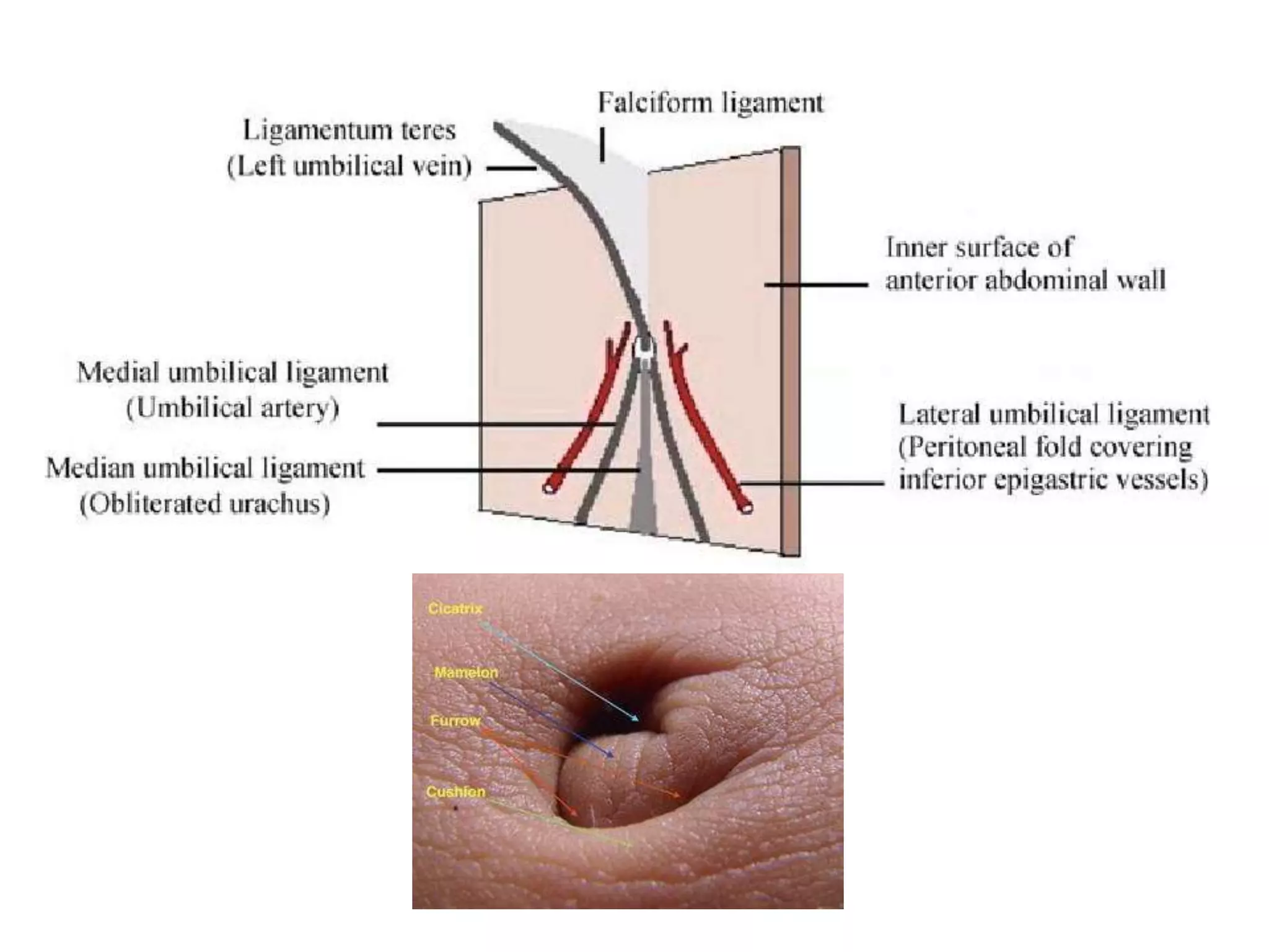 Umbilical, paraumbilical, incisional hernia revision | PPTX