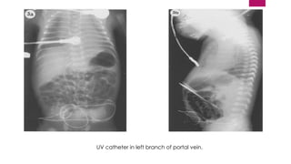 UMBILICAL VASCULAR CATHETERIZATION (1) [Autosaved].pptx
