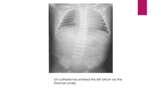 UMBILICAL VASCULAR CATHETERIZATION (1) [Autosaved].pptx