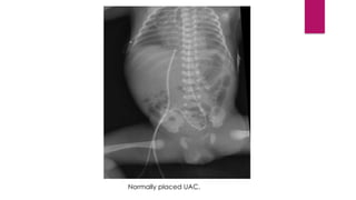 UMBILICAL VASCULAR CATHETERIZATION (1) [Autosaved].pptx