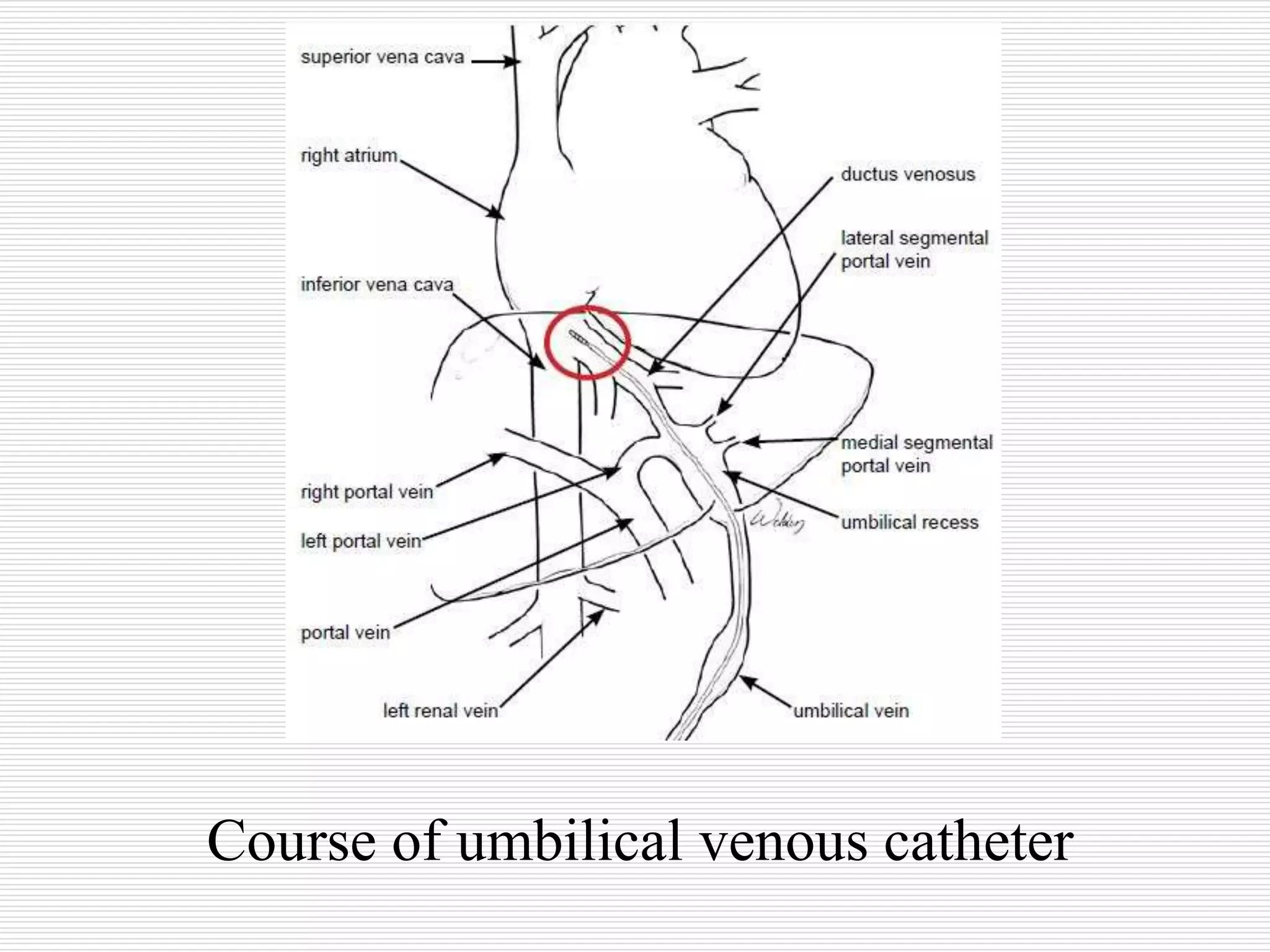 Uvc Normal Course Neonatal Umbilical Venous Catherization Radiology | PPT