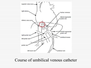 Uvc Radiopaedia Neonatal Umbilical Venous Catherization Radiology | PPT