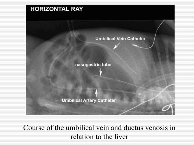 Uvc Radiopaedia Neonatal Umbilical Venous Catherization Radiology | PPT | Heart and ...