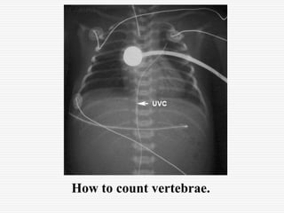 Uvc Course Neonatal Umbilical Venous Catherization Radiology | PPT