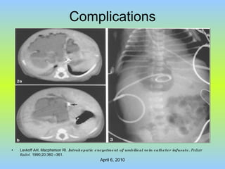 Complications Levkoff AH, Macpherson RI.  Intrahepatic encystment of umbilical vein catheter infusate.   Pediatr Radiol.  1990;20:360 –361. 