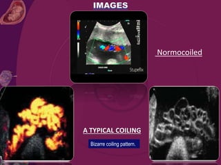 Normocoiled
A TYPICAL COILING
Bizarre coiling pattern.
 